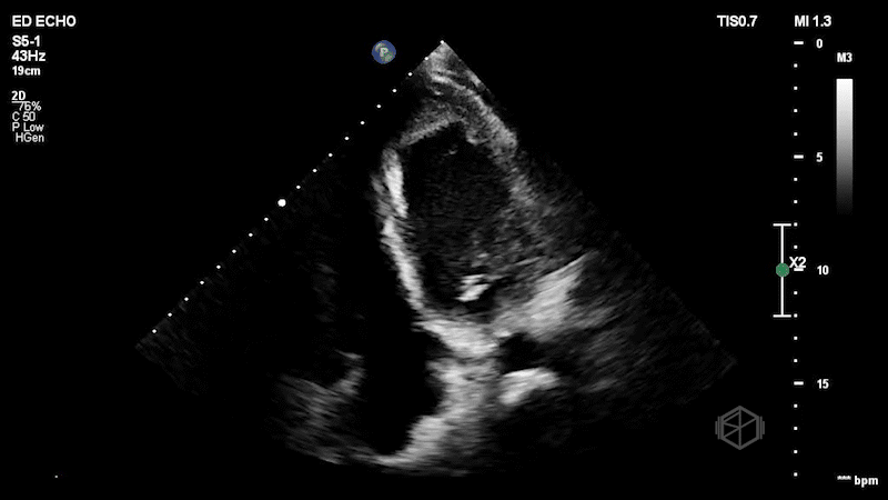 Apical 4 with large apical thrombus