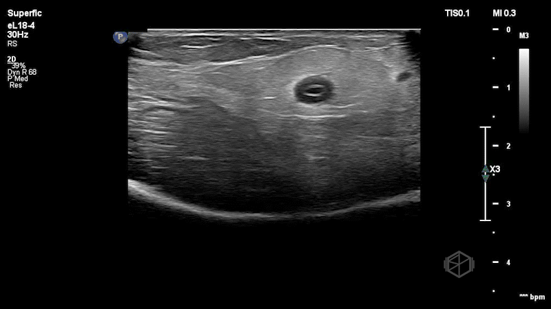 SP32025-Phlebitis1.gif