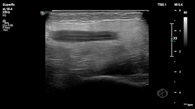SP32025-Phlebitis2.gif