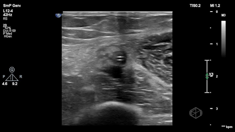 SP51525-MidlineDVT2.gif