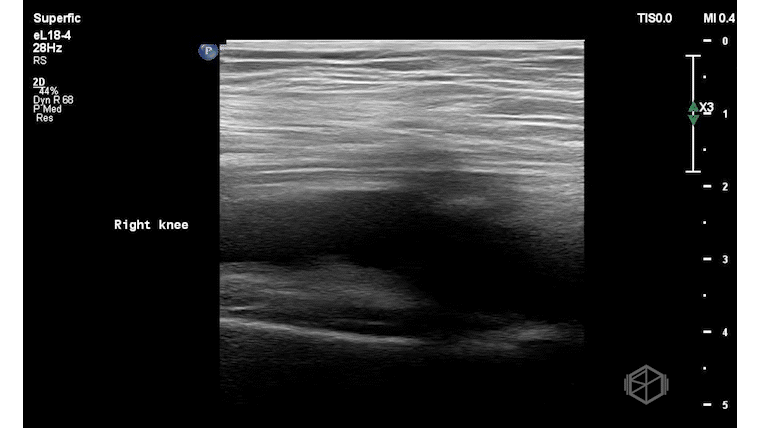 SP-Knee_1.gif