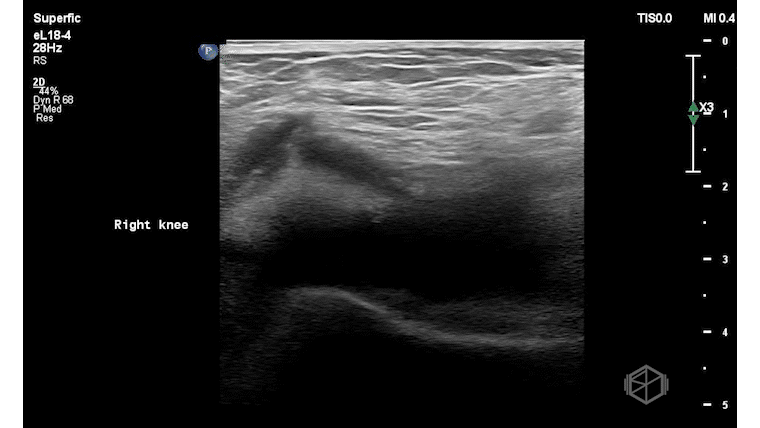 SP-Knee2_1.gif