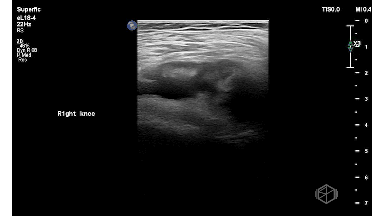SP-Knee3_1.gif