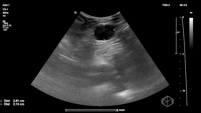 Rectus Hematoma 1.gif