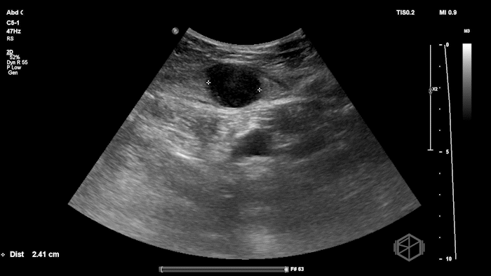 Rectus Hematoma 2.gif