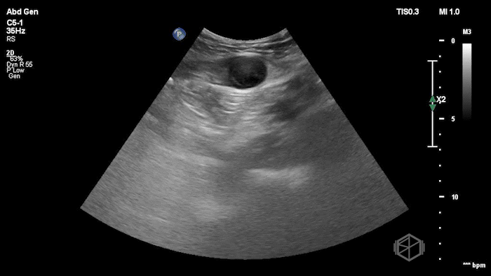 Rectus Hematoma 3.gif