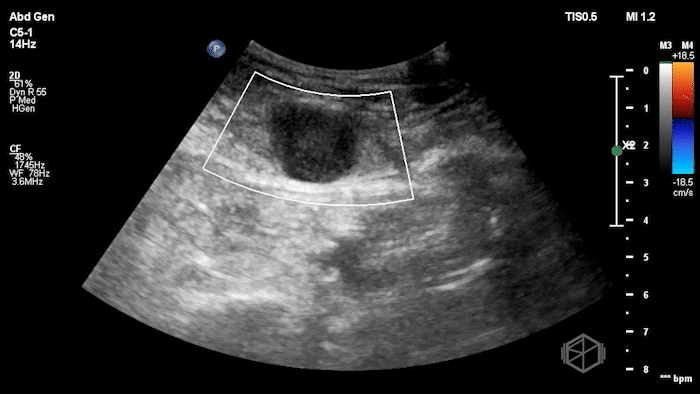 Rectus Hematoma 5.gif