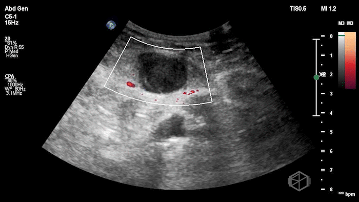 Rectus Hematoma 6.gif