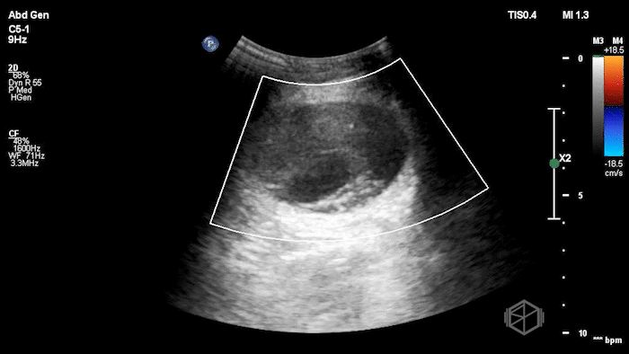 StrangulatedHernia2.gif