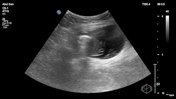 StrangulatedHernia3.gif