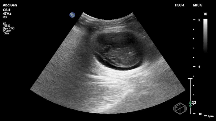 StrangulatedHernia4.gif