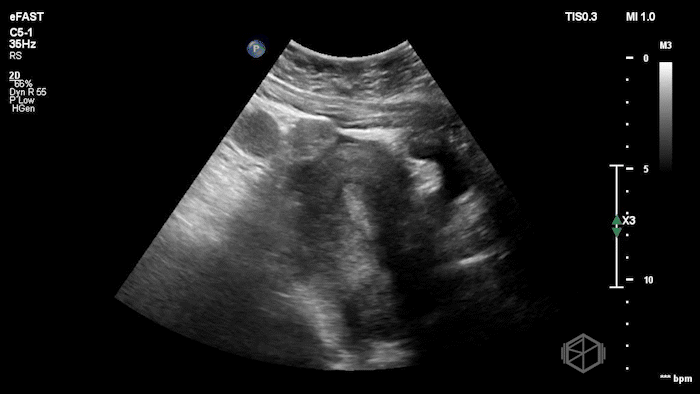 RadnexalEctopic3.gif