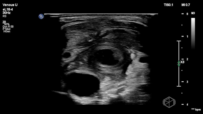 L-IJ Thrombus - Thrombophlebitis 01.gif