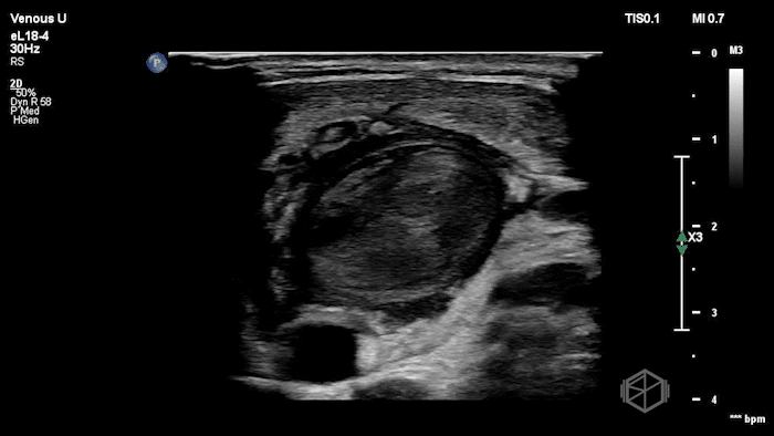L-IJ Thrombus - Thrombophlebitis 03.gif