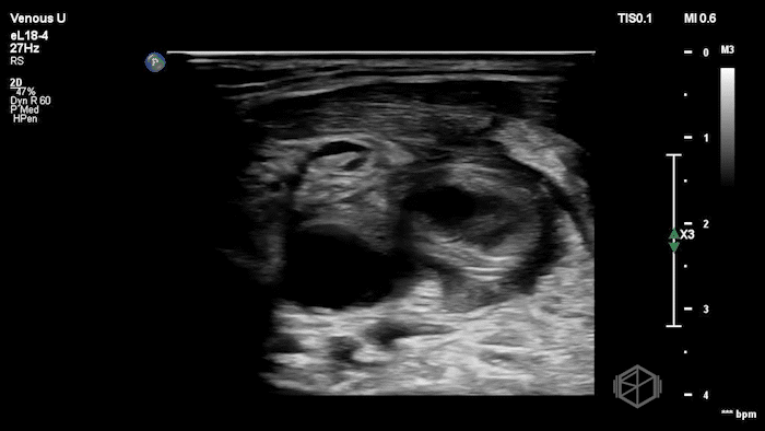 L-IJ Thrombus - Thrombophlebitis 06.gif