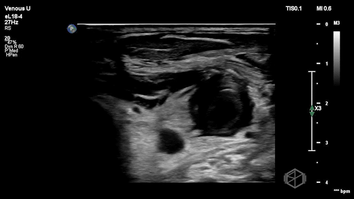 L-IJ Thrombus - Thrombophlebitis 07.gif
