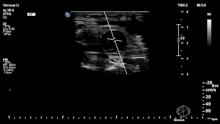 L-IJ Thrombus - Thrombophlebitis 08.gif