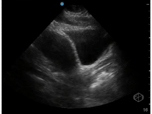 Bladder Transverse (Female)