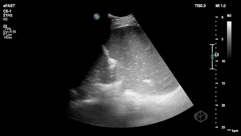 Left upper quadrant ultrasound demonstrating a hiatal hernia with stomach herniating through.