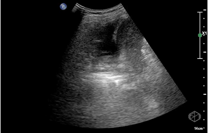 B-lines along the lung base near consolidated lung.