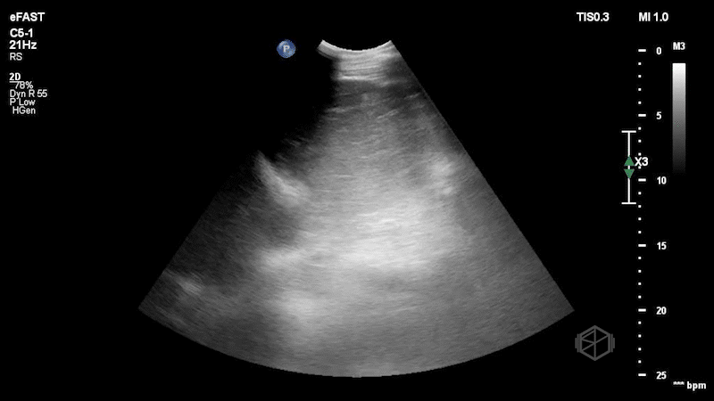 The stomach is swirling with food contents and is visible on both sides of the diaphragm.
