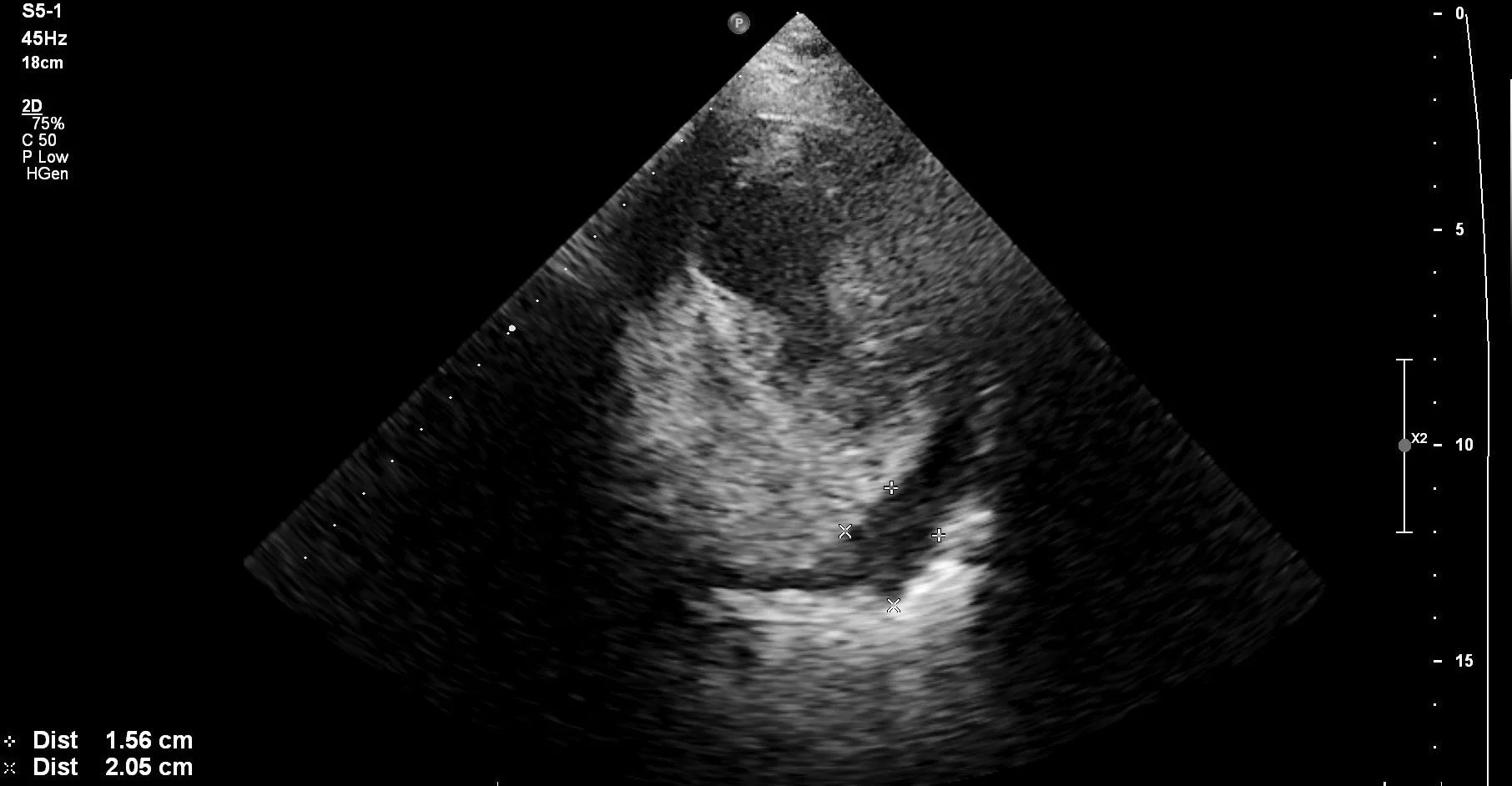 PSS pericardial effusion measurement