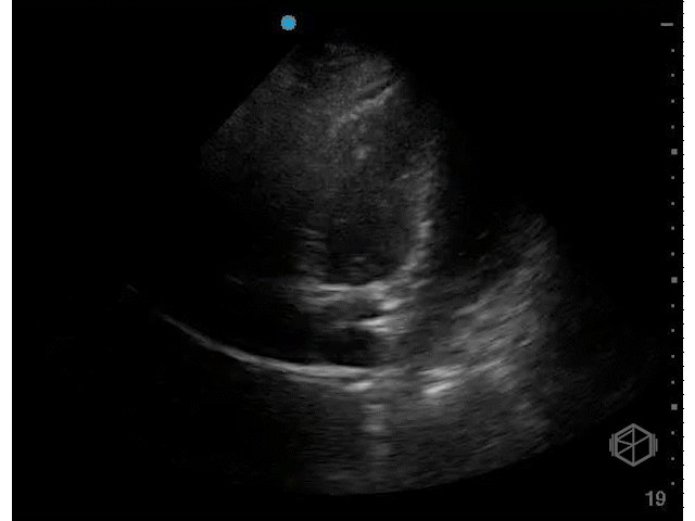 Septal displacement toward RV — RV pressure overload (PE)
