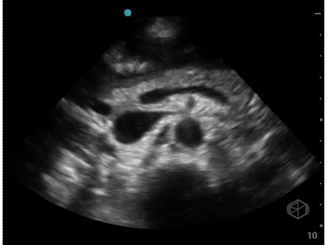 Normal Mid Aorta