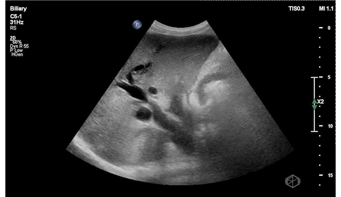 Intrahepatic biliary duct dilation