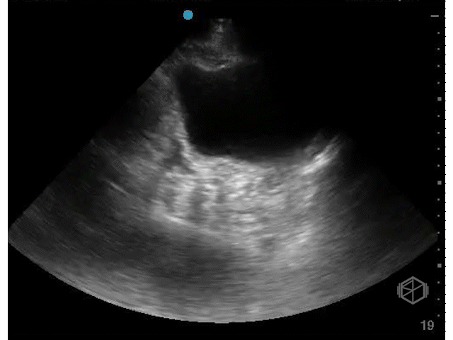 +Free fluid, male, note how the high gain makes it difficult to see free fluid.