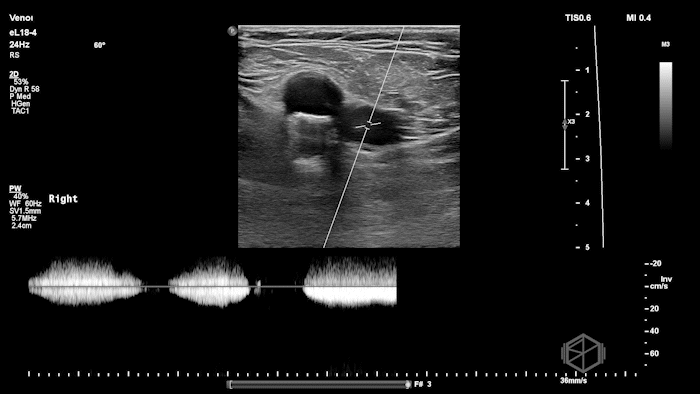 Pulse-wave doppler showing normal phasicity.
