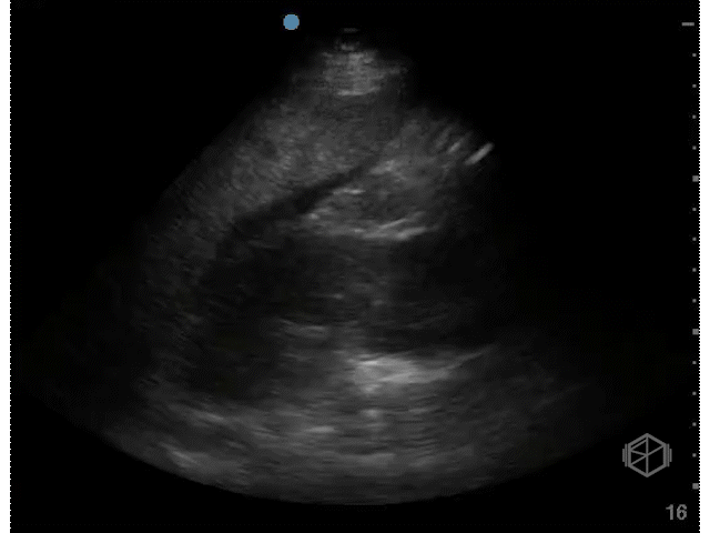 Positive Hepatorenal (Morrison's Pouch)