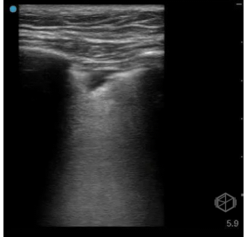  Subpleural consolidation  — small or large hypoechoic regions disrupting the pleural line.