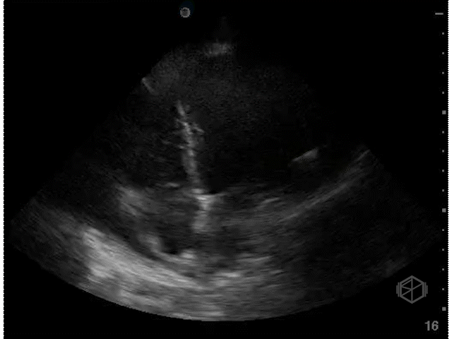 Right atrial systolic collapse