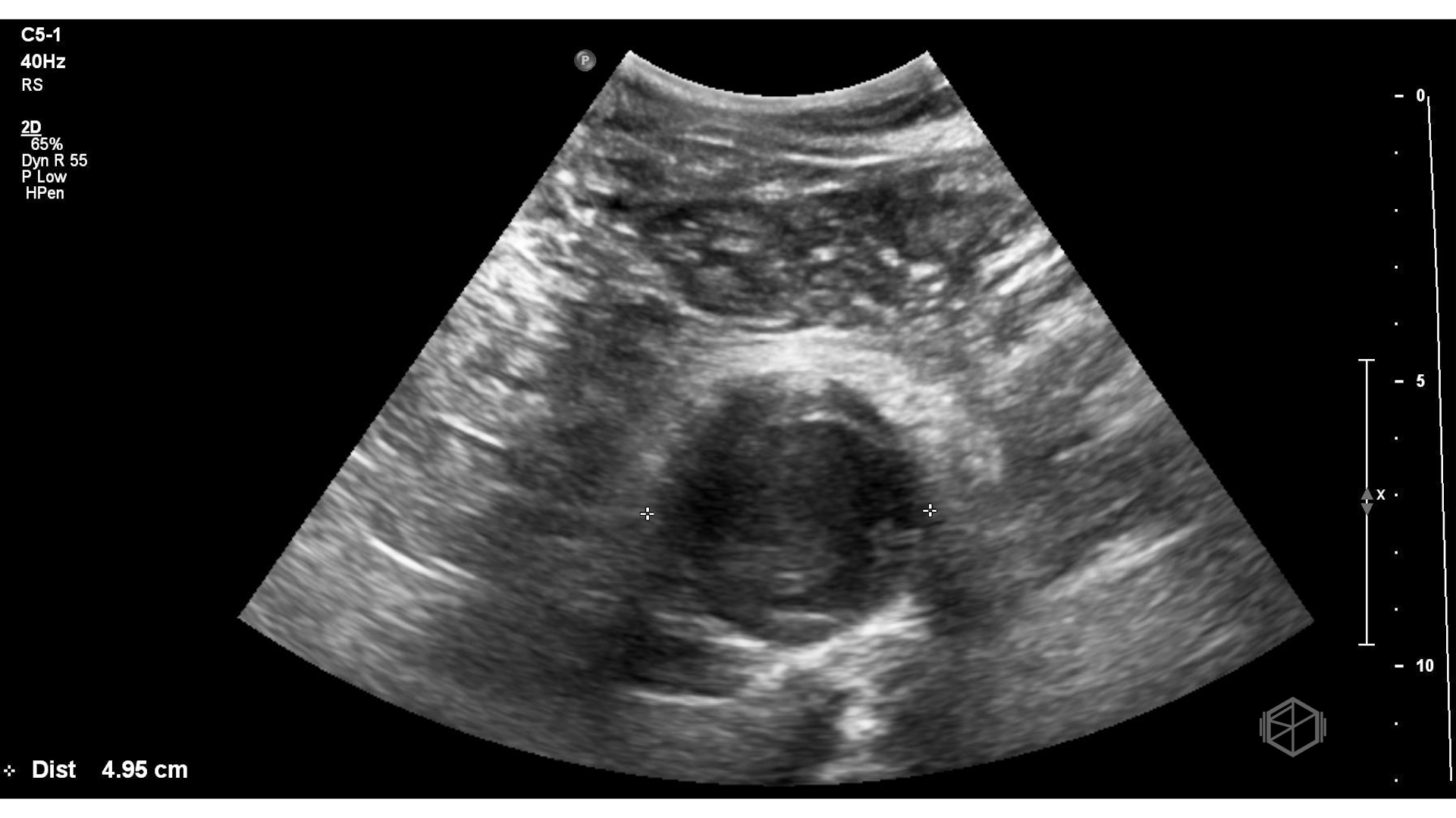 Any measurement of an AAA with a thrombus should be outer wall to outer wall and include the thrombus.
