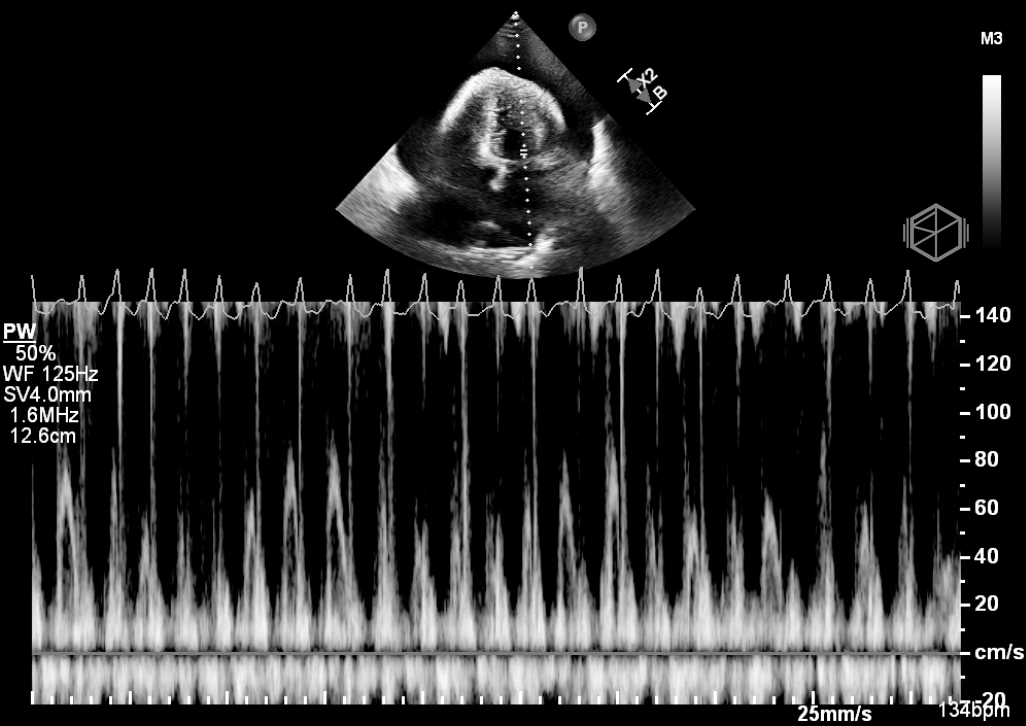 Significant mitral inflow variation >25%