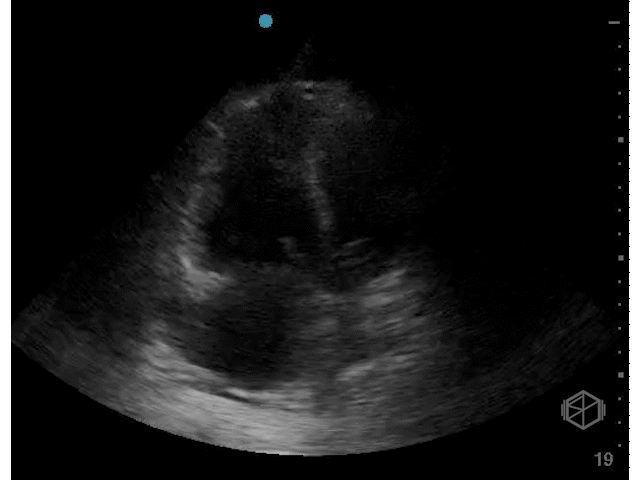 Septal displacement toward LV during diastole — RV volume overload.