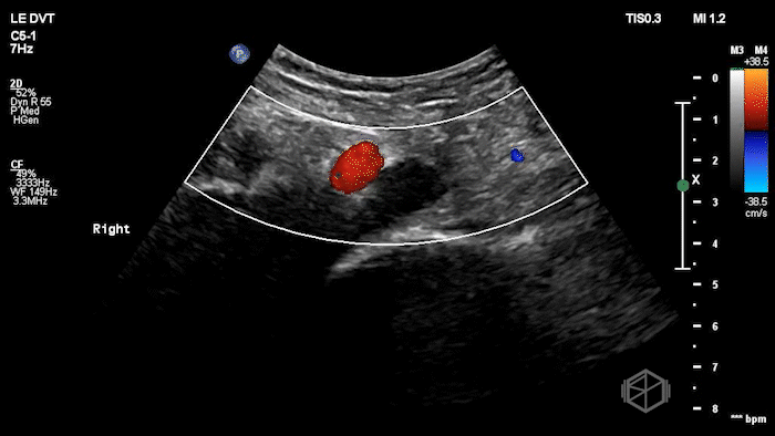 Iliac vein thrombus with absent color Doppler flow.