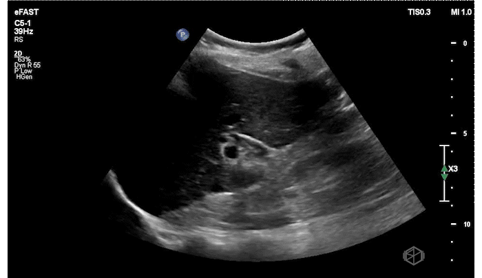 CBD Post-cholecystectomy