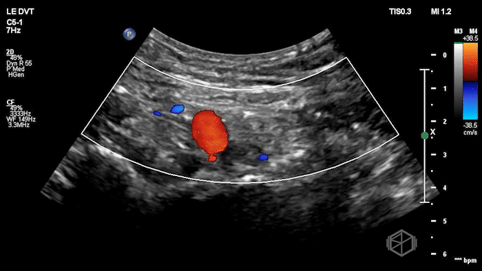 Iliac vein DVT with incomplete color Doppler filling of the lumen