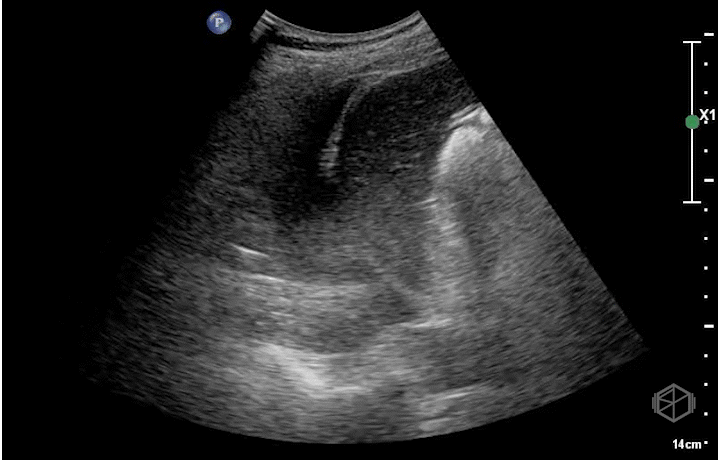 Hepatization of lung with a small parapneumonic pleural effusion (anechoic space). Note the air bronchograms.