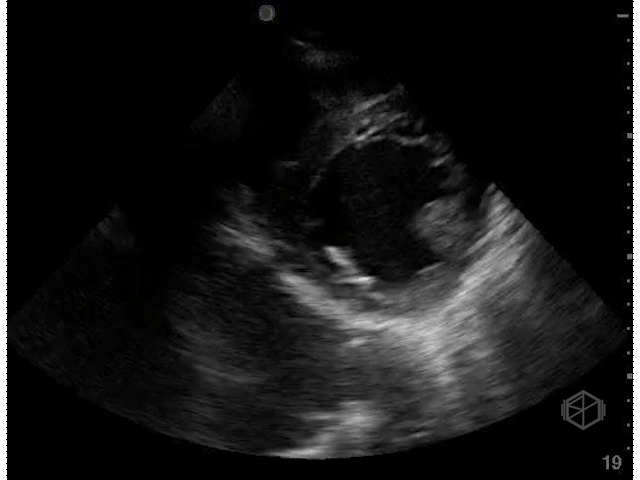 Severely hypodynamic LVEF (~15%)