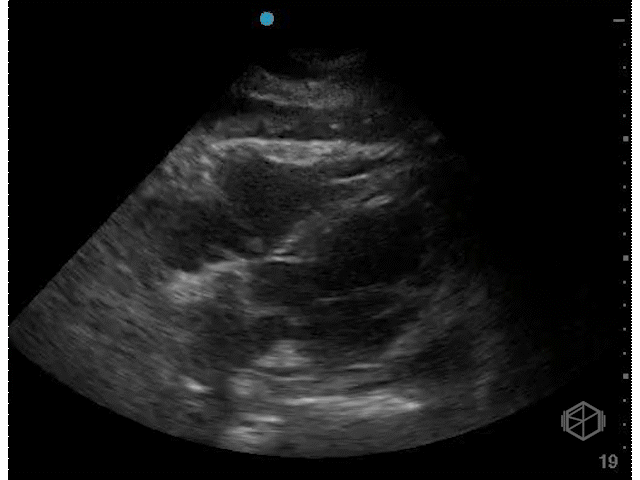 Pericardial fat pad and pericardial effusion — note the pericardial fat pad moving in concert with the right heart while the pericardial effusion is circumferential.