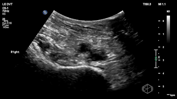 Echogenic clot visible in the iliac vein.
