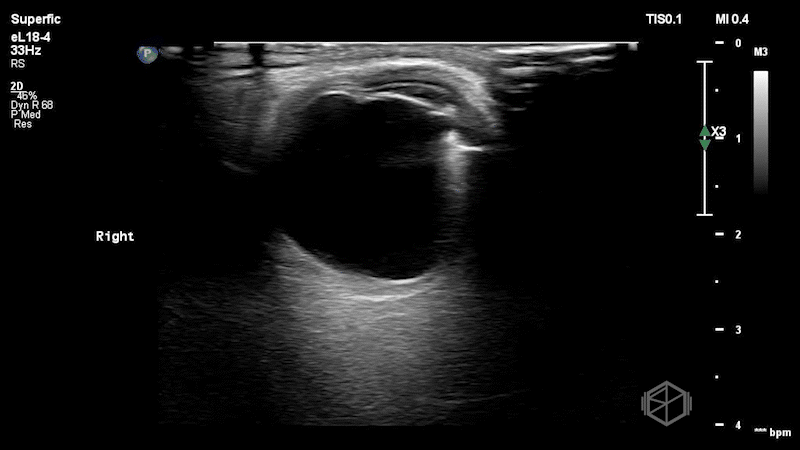 Hyperechoic linear structure penetrating the globe, concerning for a retained metallic intraocular foreign body. This bedside finding prompted immediate ophthalmology consultation, initiation of antibiotics, and urgent transfer for surgical managemen