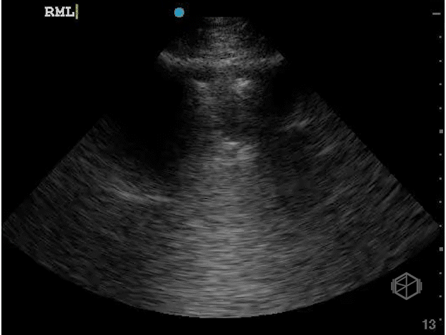      Shred sign      — subpleural hypoechoic area with irregular/ragged margins.