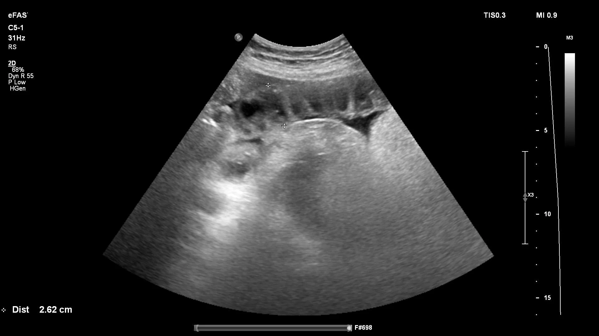 Bowel   2.5cm, Tanga Sign, Bowel Wall Edema