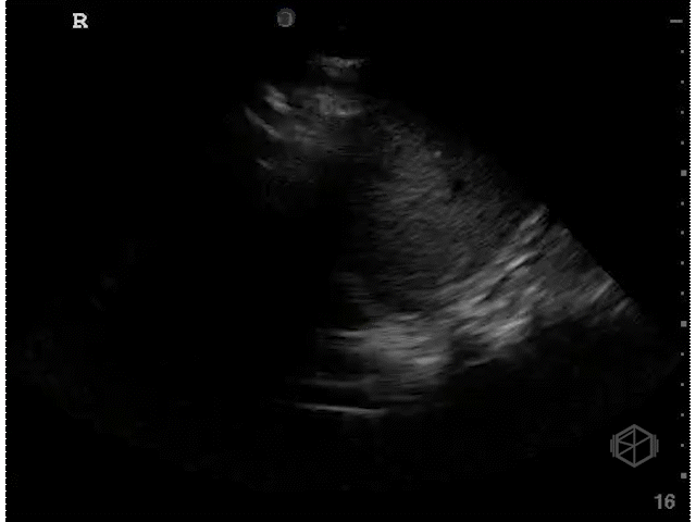 Normal lung base demonstrating the "curtain sign." The aerated lung prevents the transmission of sound waves.