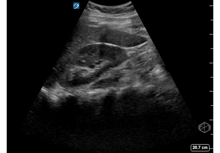 Small volume free fluid at the caudal liver edge.