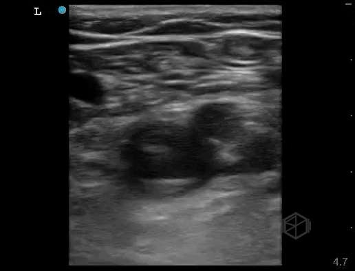 Common femoral DVT, echogenic. 